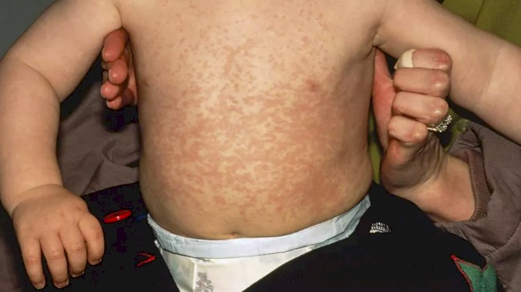 Brüksel kanalizasyon sularında kızamık virüsü tespit edildi